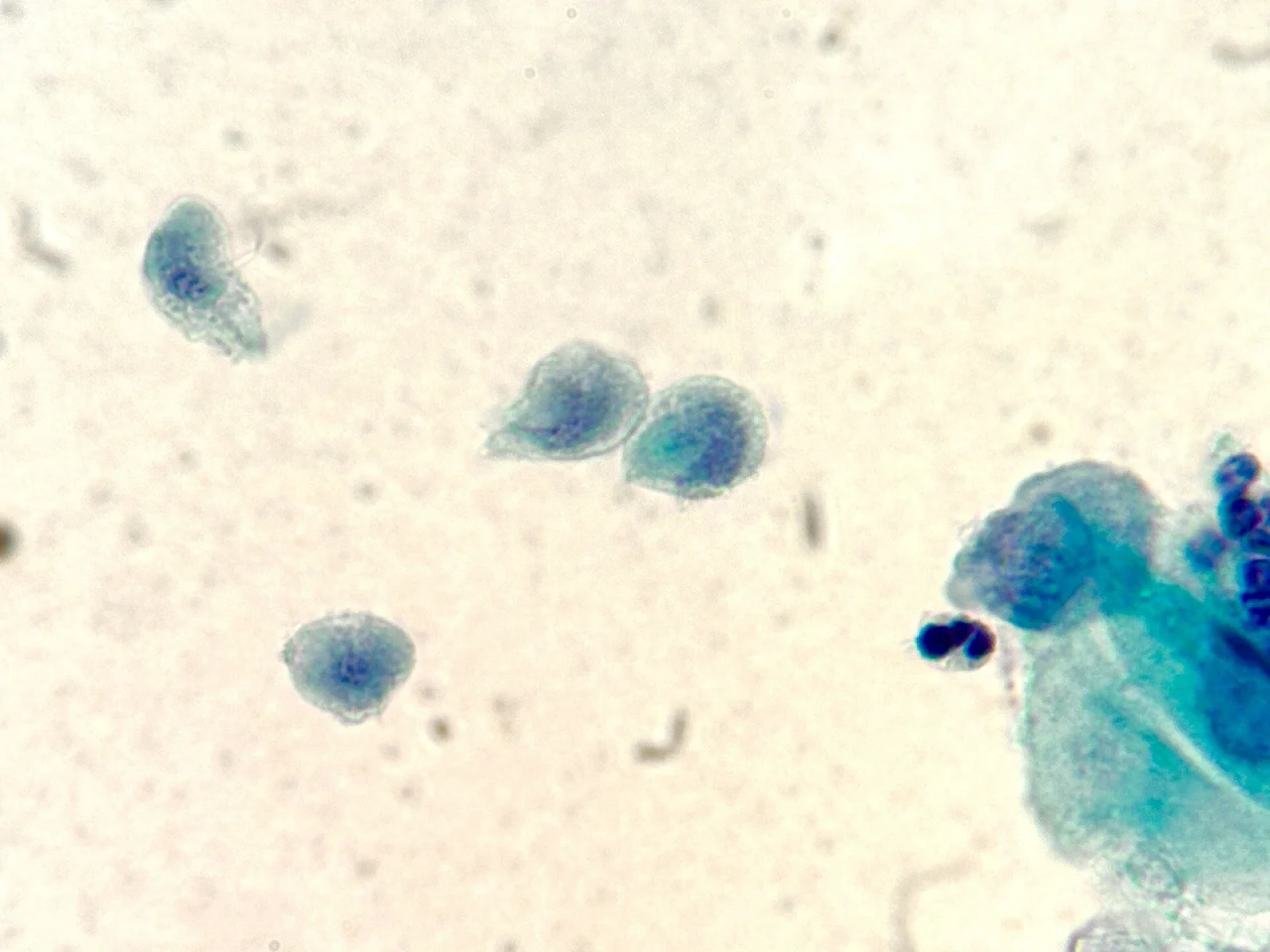 阴道分泌物涂片染色效果示意图:梨形的滴虫和鳞状上皮细胞